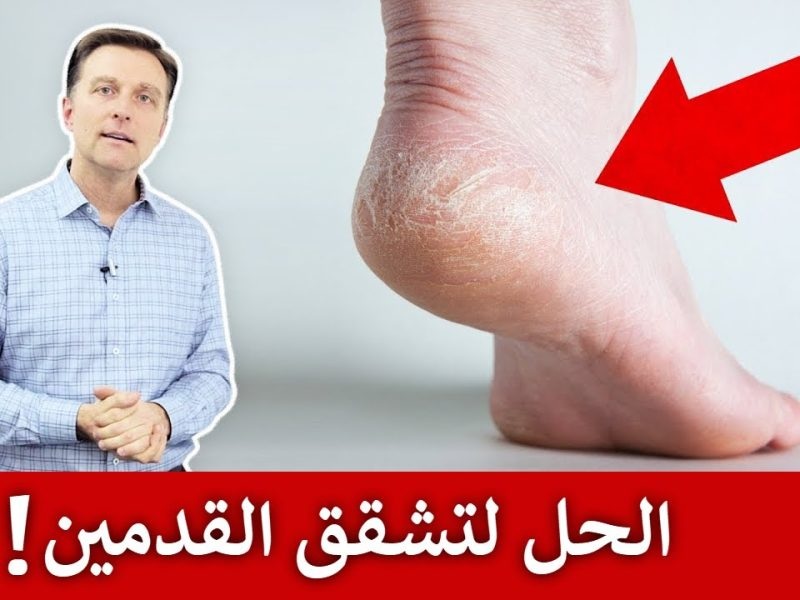 طريقة التخلص من التشققات وجفاف القدمين وجعلهم ناعمتين