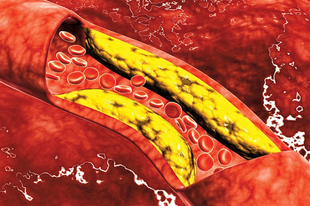 أول علامة خطيرة على ارتفاع مستوى الكوليسترول في الدم.. ماذا تعني؟