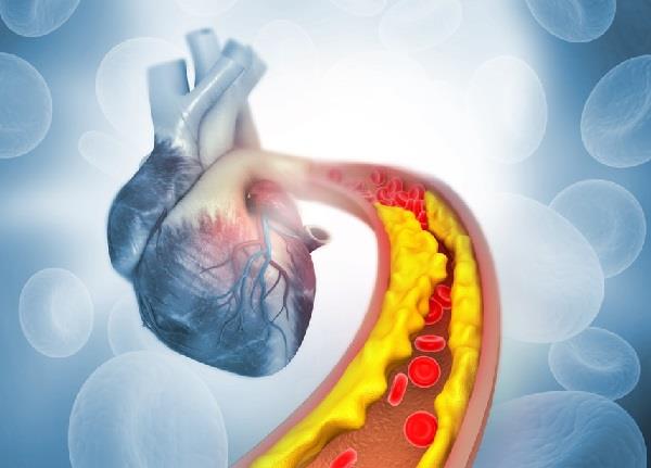 طبيب يكشف علامات مرض الشريان التاجي.. تعرف عليها