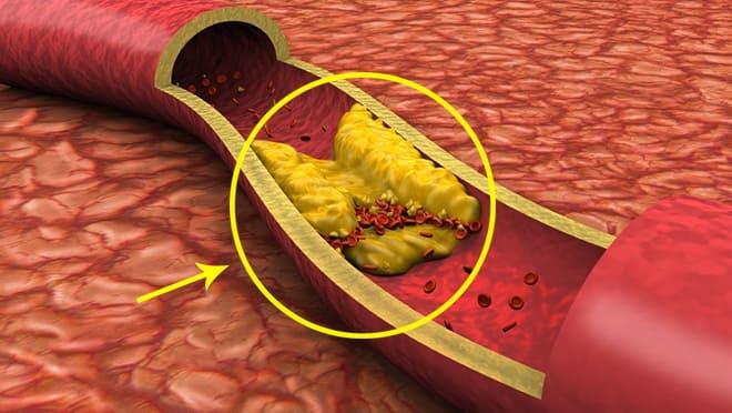 4 علامات تحذيرية تشير إلى تراكم الدهون في الشرايين.. تعرف عليها