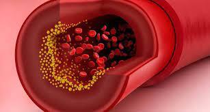 تظهر على جسمك.. طبيب في السعودية يحذر من 3 علامات خطيرة لارتفاع الكوليسترول في الدم