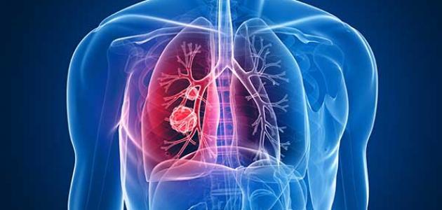 احذرها.. علامات غير متوقعة تكشف الإصابة بـ سرطان الرئة